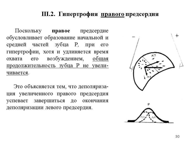 III.2. Гипертрофия правого предсердия Поскольку правое III.2. Гипертрофия правого предсердия Поскольку правое